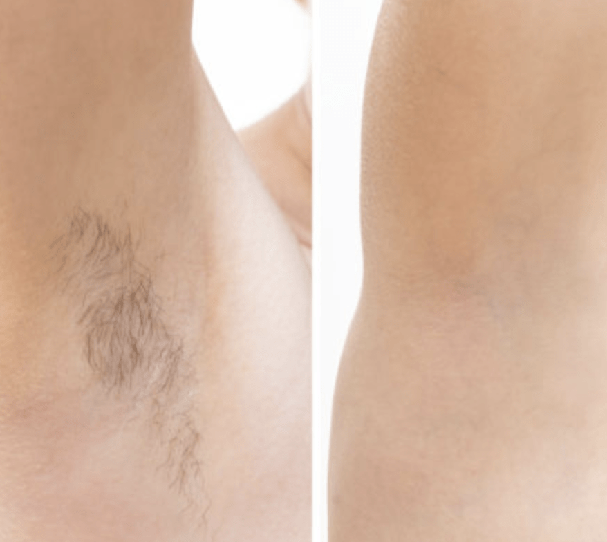 epilation 1