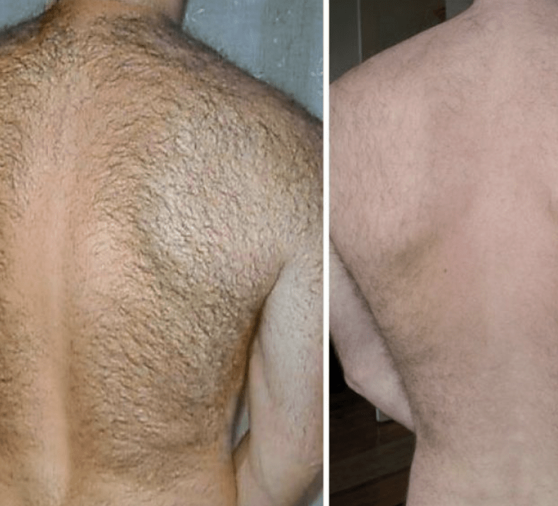 epilation2